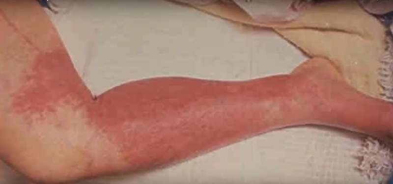 Resultado de imagem para celulite bacteriana