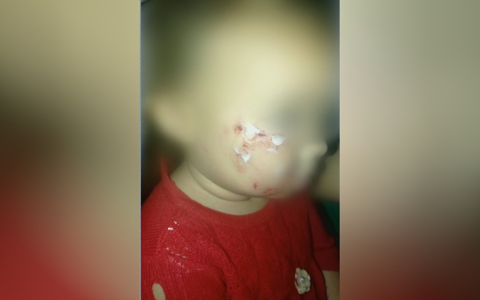 Criana mordida por cachorro no rosto em Goinia Foto ReproduoTV Anhanguera