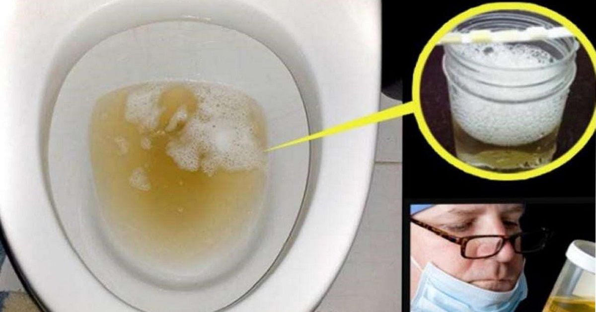 Nunca ignore estas 7 causas de urina com espuma e saiba o que fazer ...