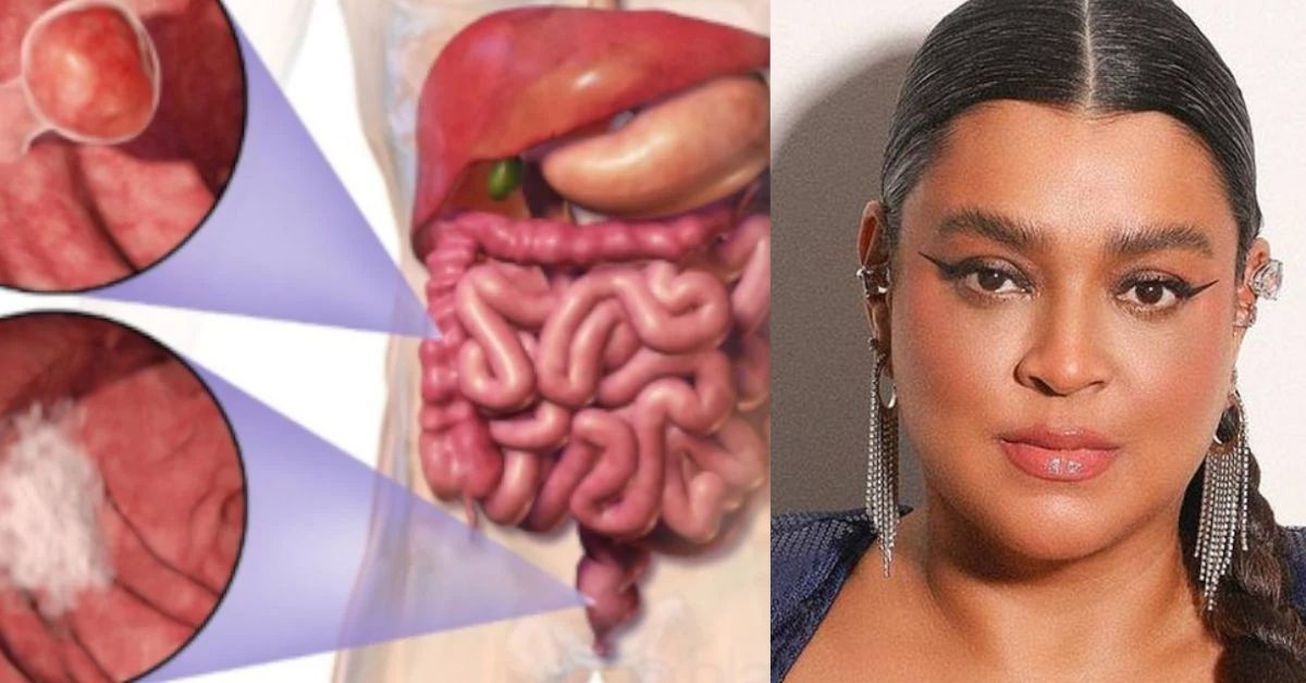 Adenocarcinoma de cólon: Sintomas do câncer que acometeu Preta Gil