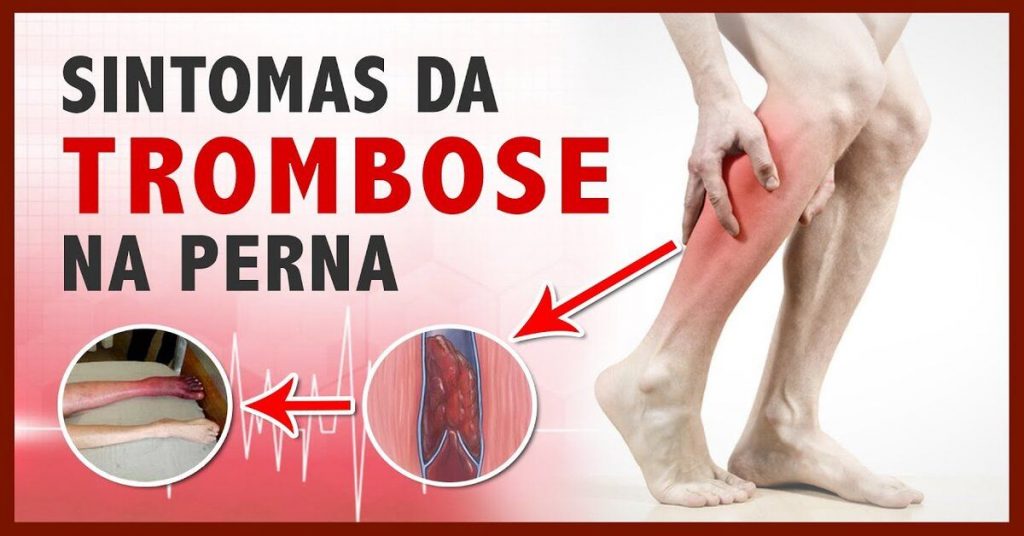 Trombose: Entenda Os Sintomas, Causas E Tratamentos Da Doença Que Levou ...