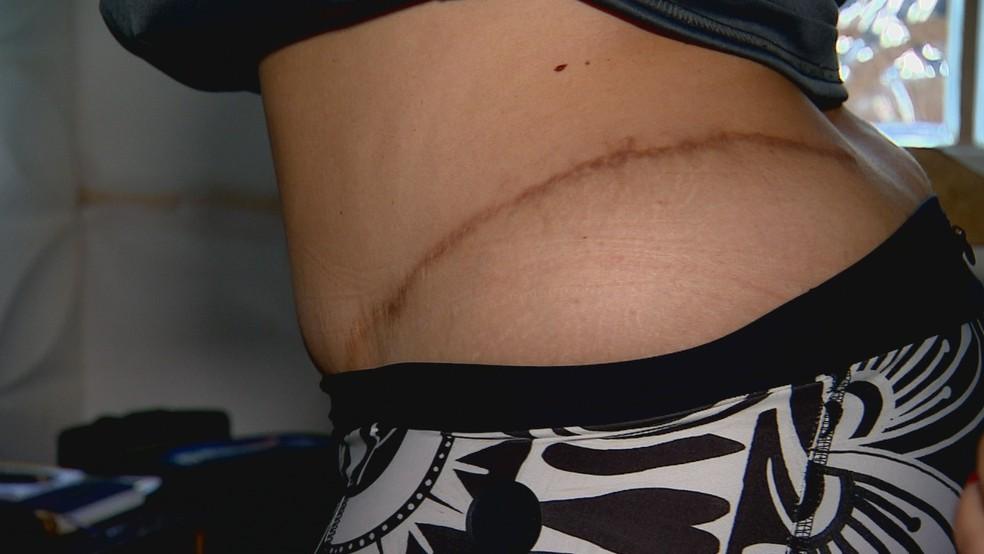 Paciente ficou com cicatriz aps a cirurgia Foto ReproduoRBS TV